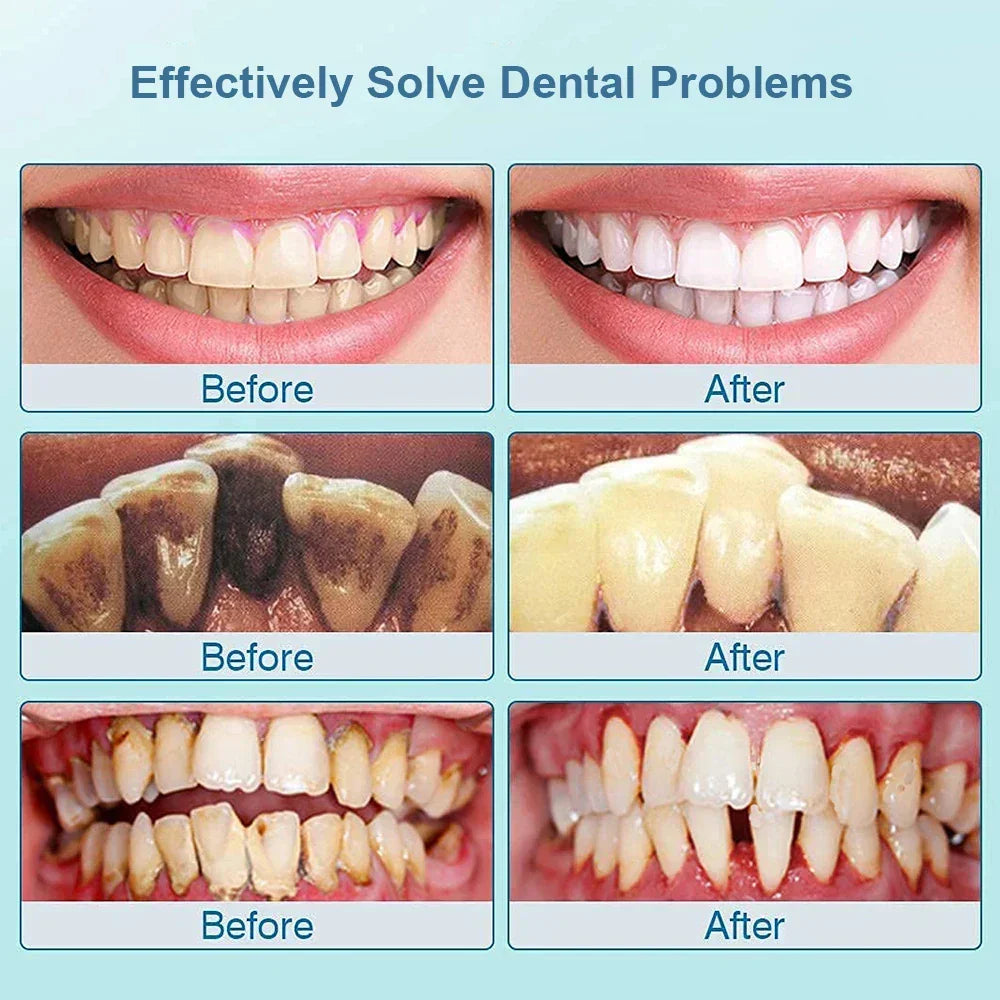 Ultrasonic Tooth Cleaner - SonicClean